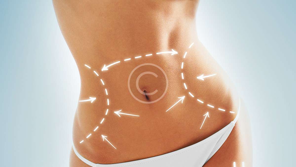 Cosmetic procedure removes excess fat