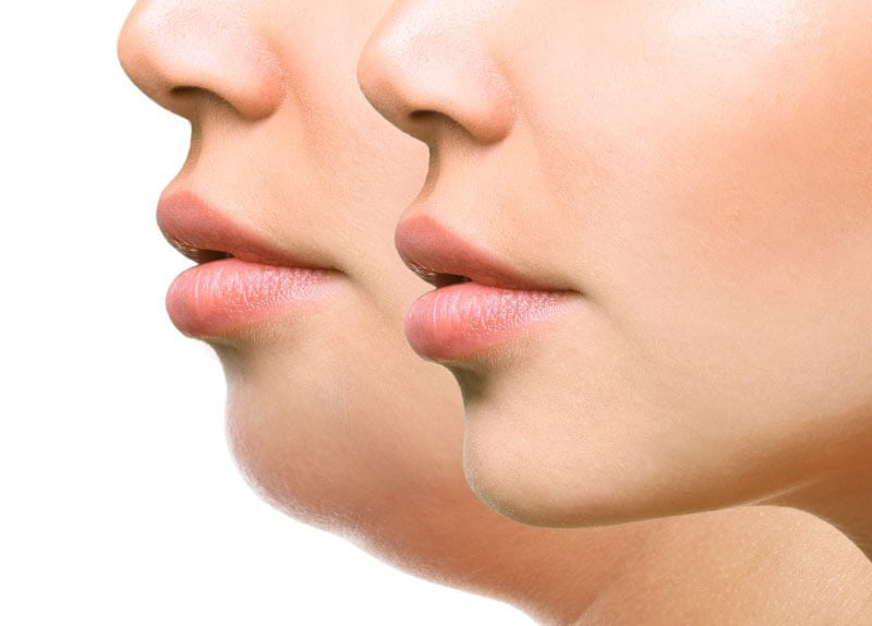 chin-surgical