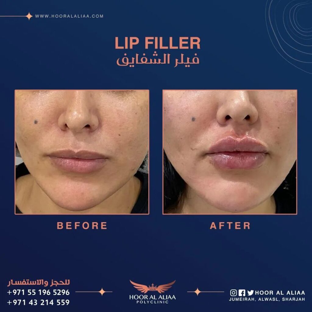 Lip filler in Dubai by dr haider al khayat at hoor al aliaa poly clinic case 2