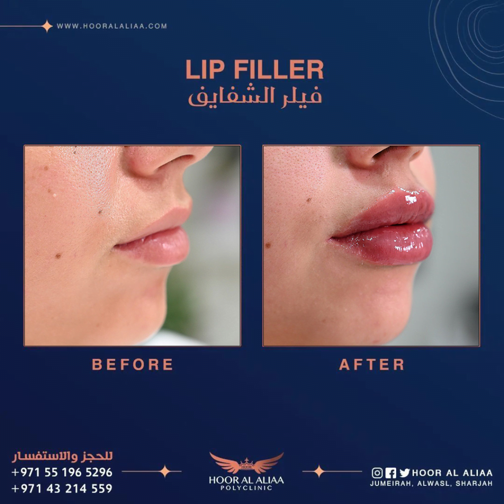 Lip filler in Dubai by dr haider al khayat at hoor al aliaa poly clinic case 1