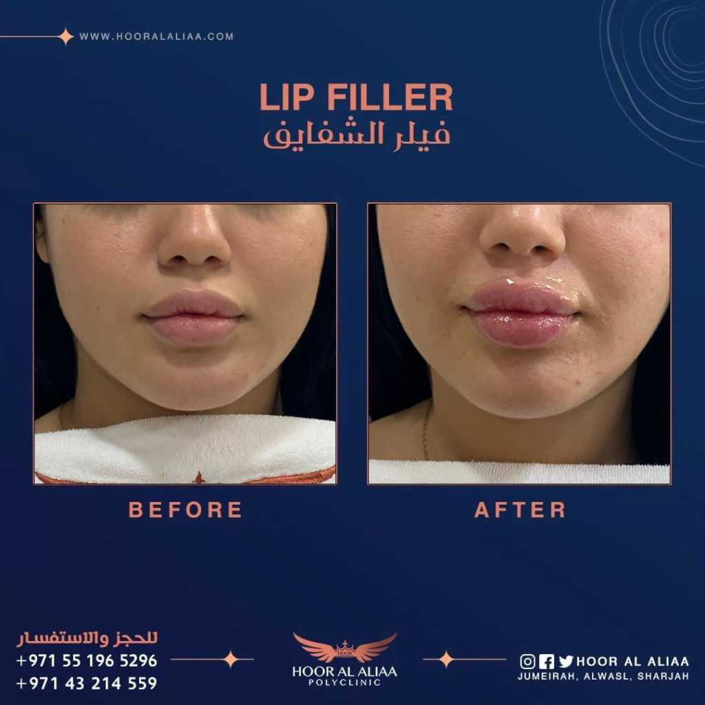 Lip filler in dubai by dr haider al khayat at hoor al aliaa poly clinic case 3