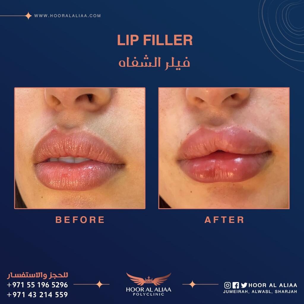 Lip filler in dubai by dr haider al khayat at hoor al aliaa poly clinic case 6